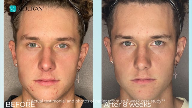 Scar Gel Advanced PDRN