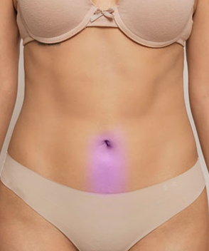 DEPILACIÓN LÁSER LÍNEA DEL OMBLIGO 6 SESIONES